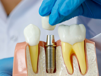 Implantes Dentários - Tatuapé