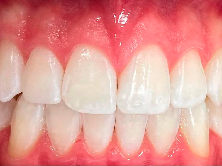 Clareamento Dental -Tatuapé