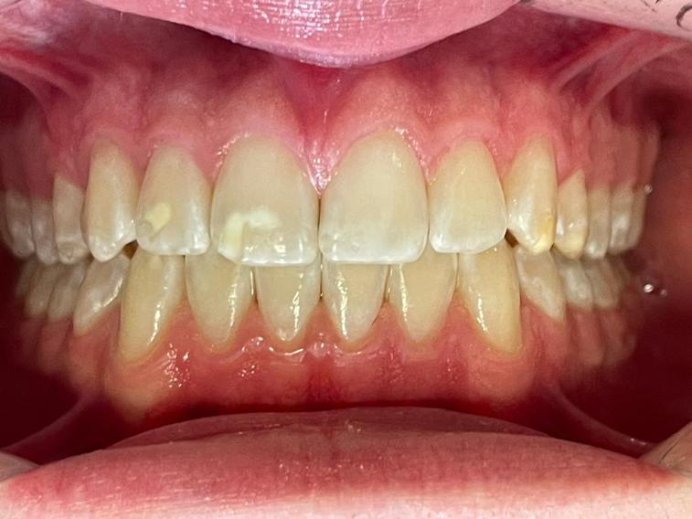 Clareamento Dental -Tatuapé